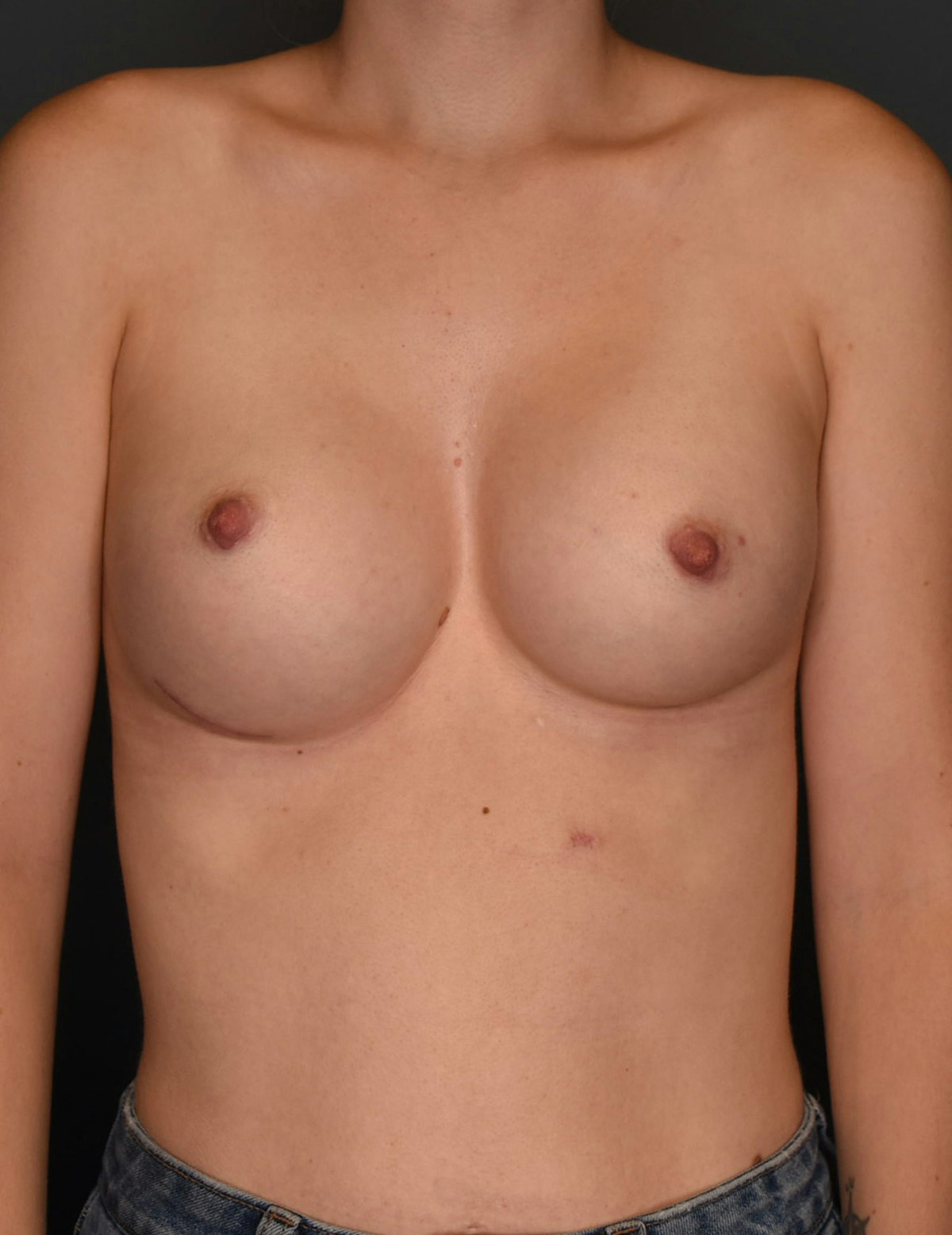 Breast Augmentation Before & After Gallery - Patient 599184 - Image 9