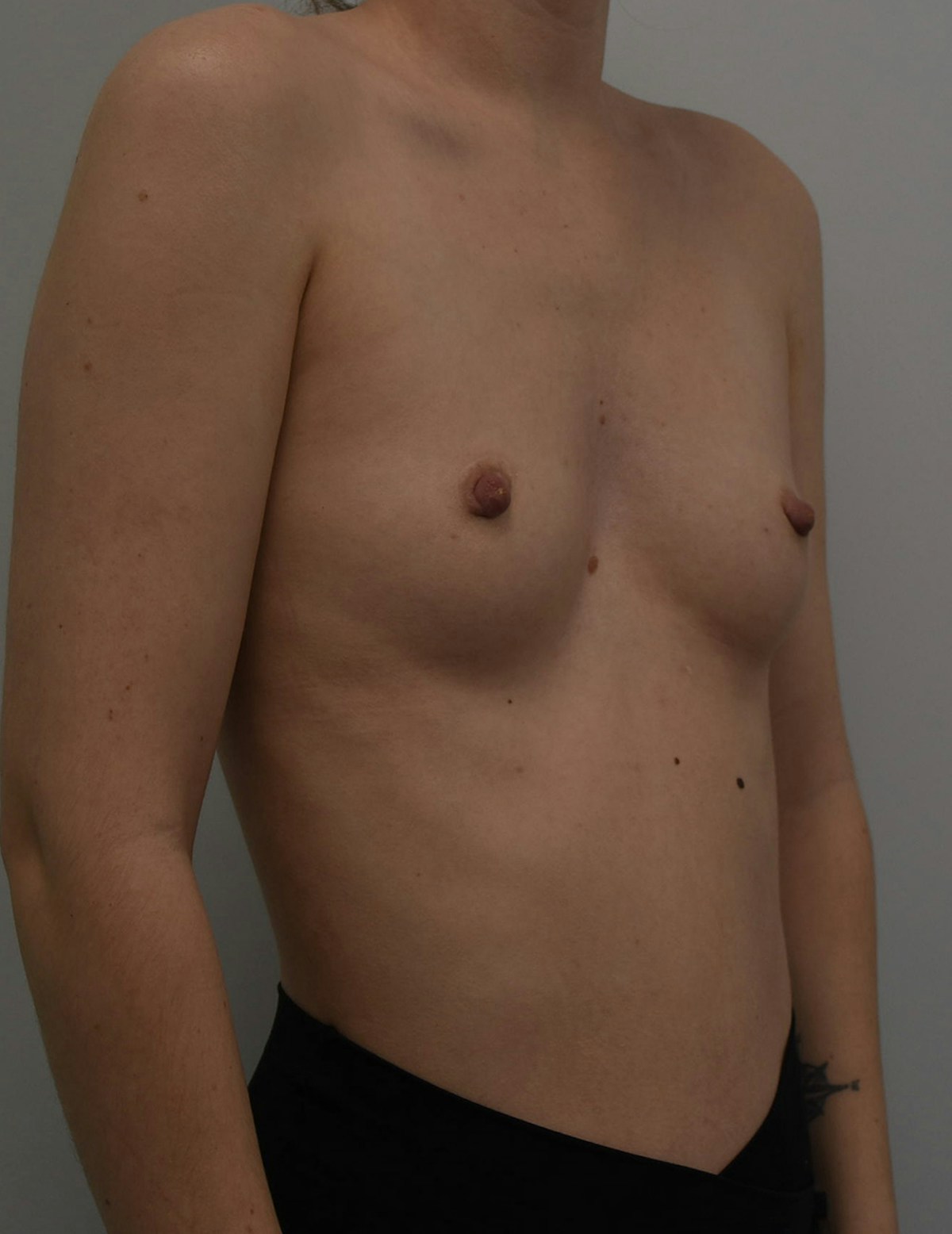 Breast Augmentation Before & After Gallery - Patient 599184 - Image 3