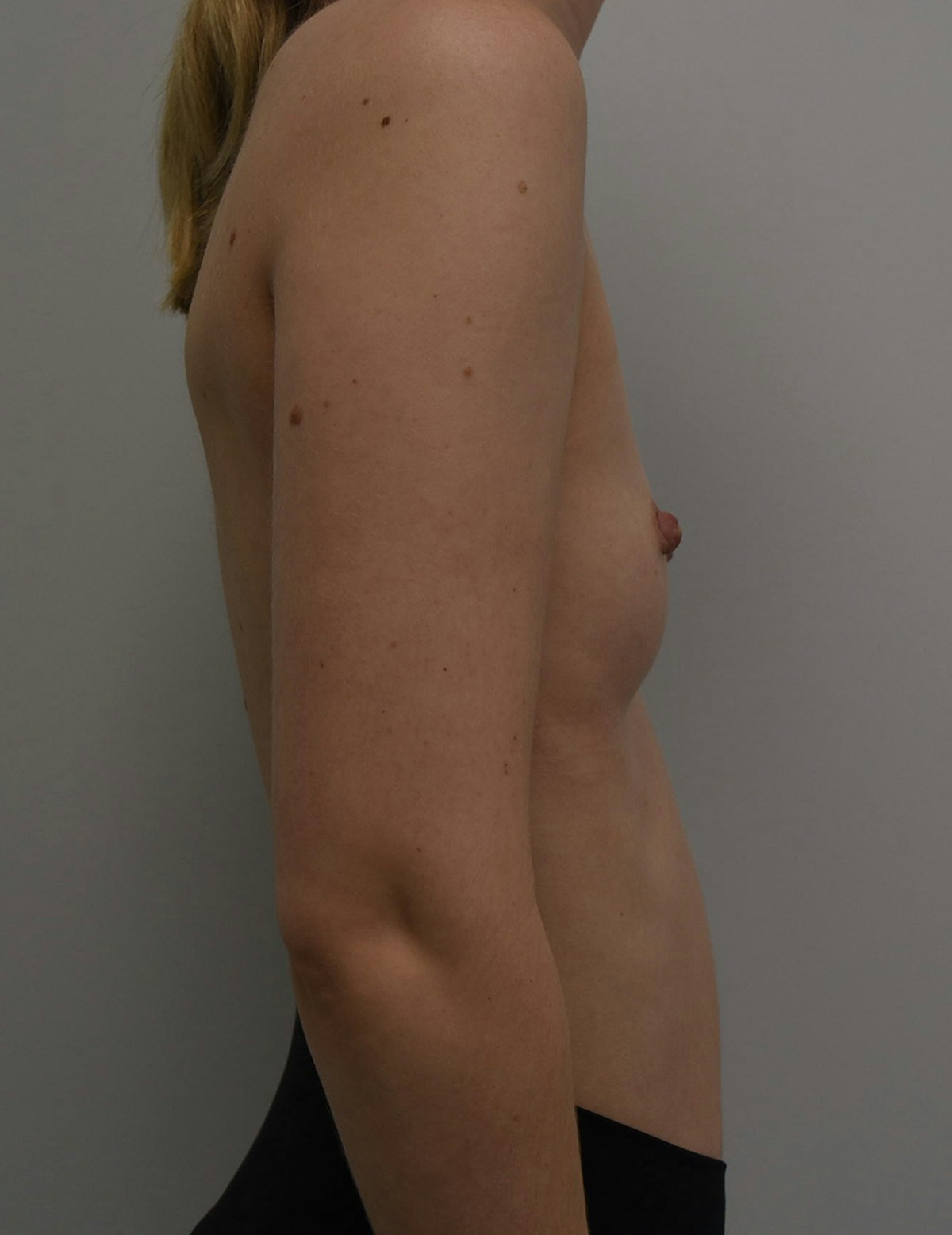 Breast Augmentation Before & After Gallery - Patient 599184 - Image 7