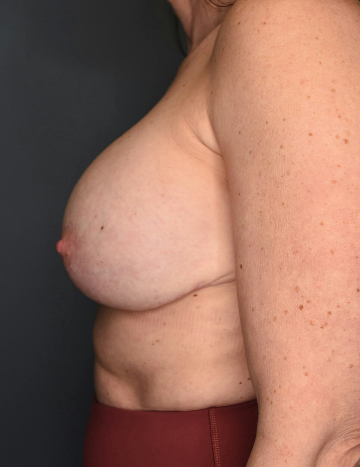 Breast Augmentation Before & After Gallery - Patient 281685 - Image 8