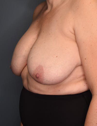 Breast Augmentation Before & After Gallery - Patient 281685 - Image 1
