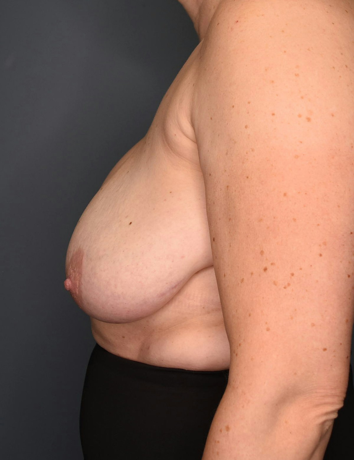 Breast Augmentation Before & After Gallery - Patient 281685 - Image 7