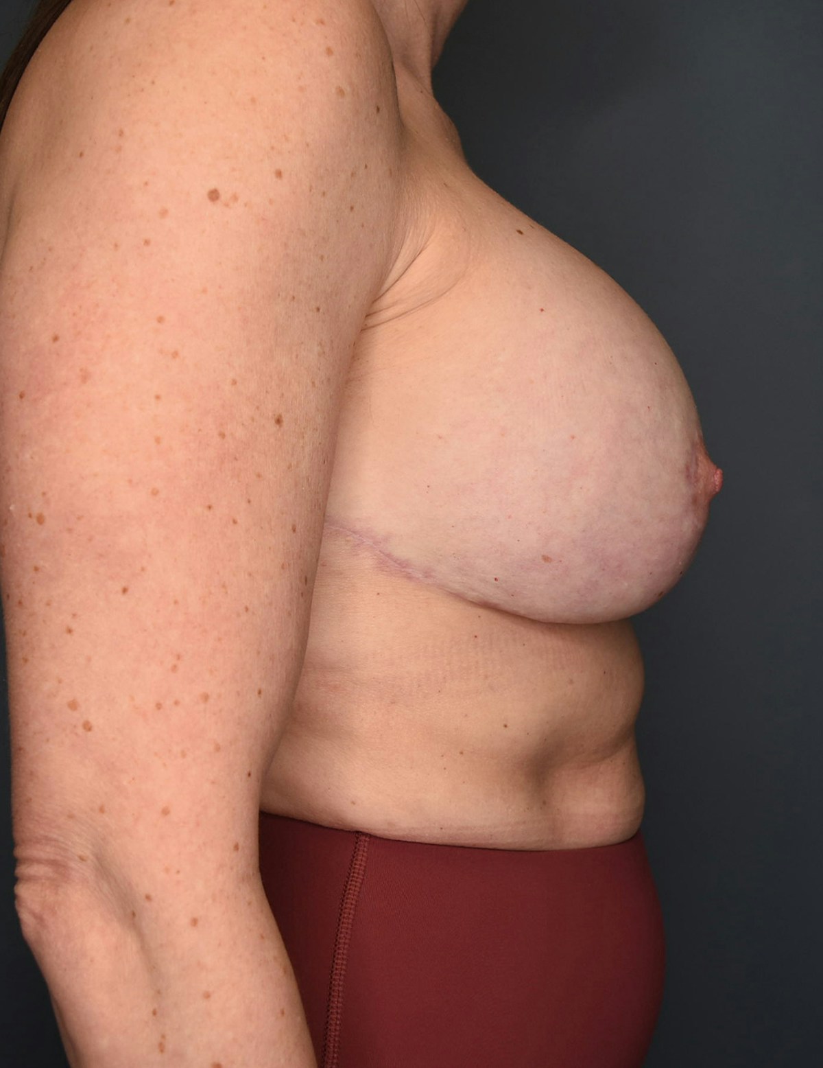 Breast Augmentation Before & After Gallery - Patient 281685 - Image 4