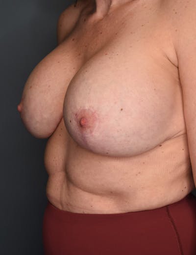 Breast Augmentation Before & After Gallery - Patient 281685 - Image 2