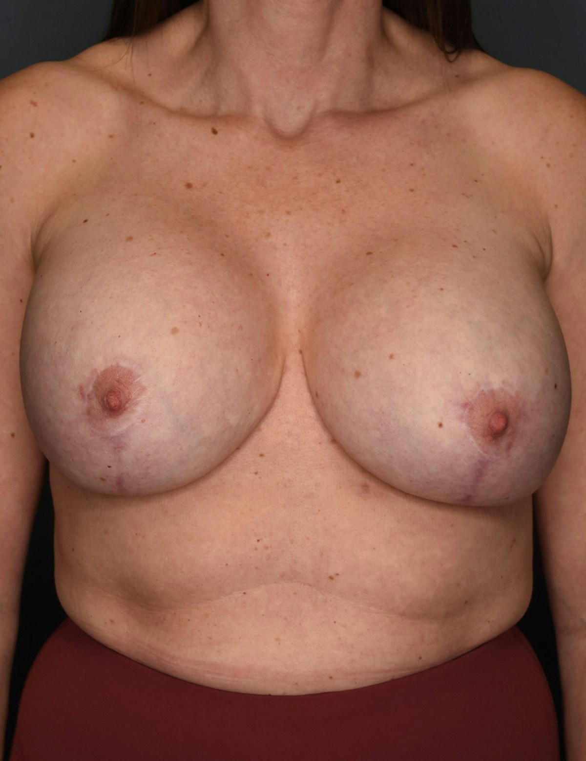 Breast Augmentation Before & After Gallery - Patient 281685 - Image 10