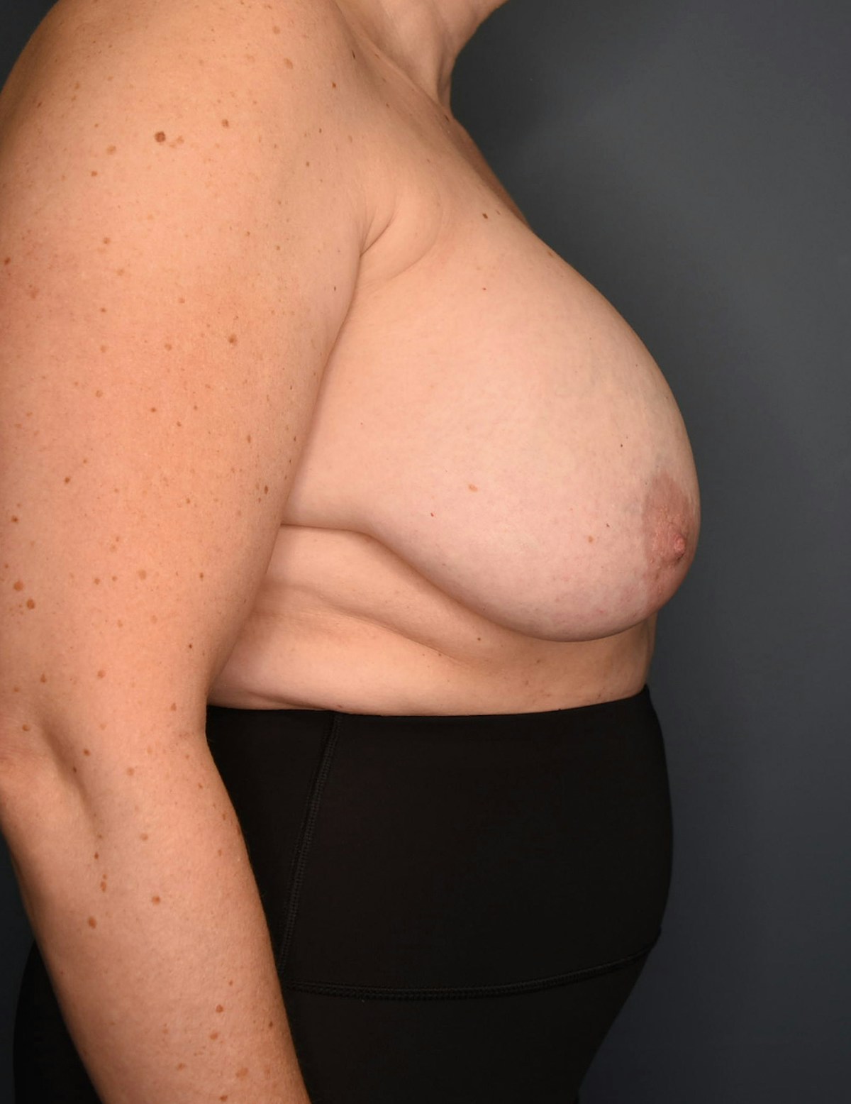 Breast Augmentation Before & After Gallery - Patient 281685 - Image 3