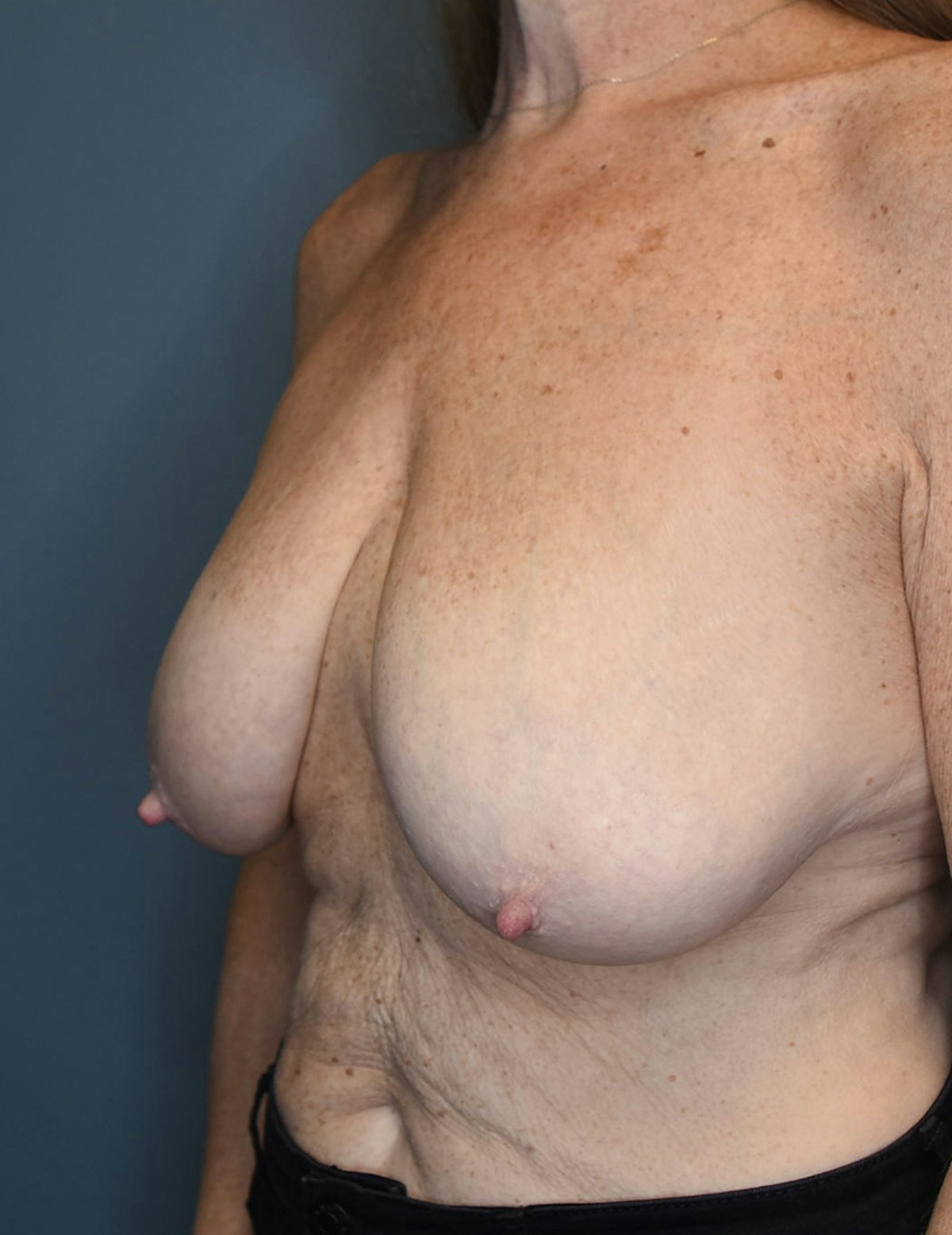 Breast Lift Before & After Gallery - Patient 546496 - Image 1