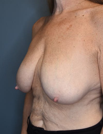 Breast Lift Before & After Gallery - Patient 546496 - Image 1