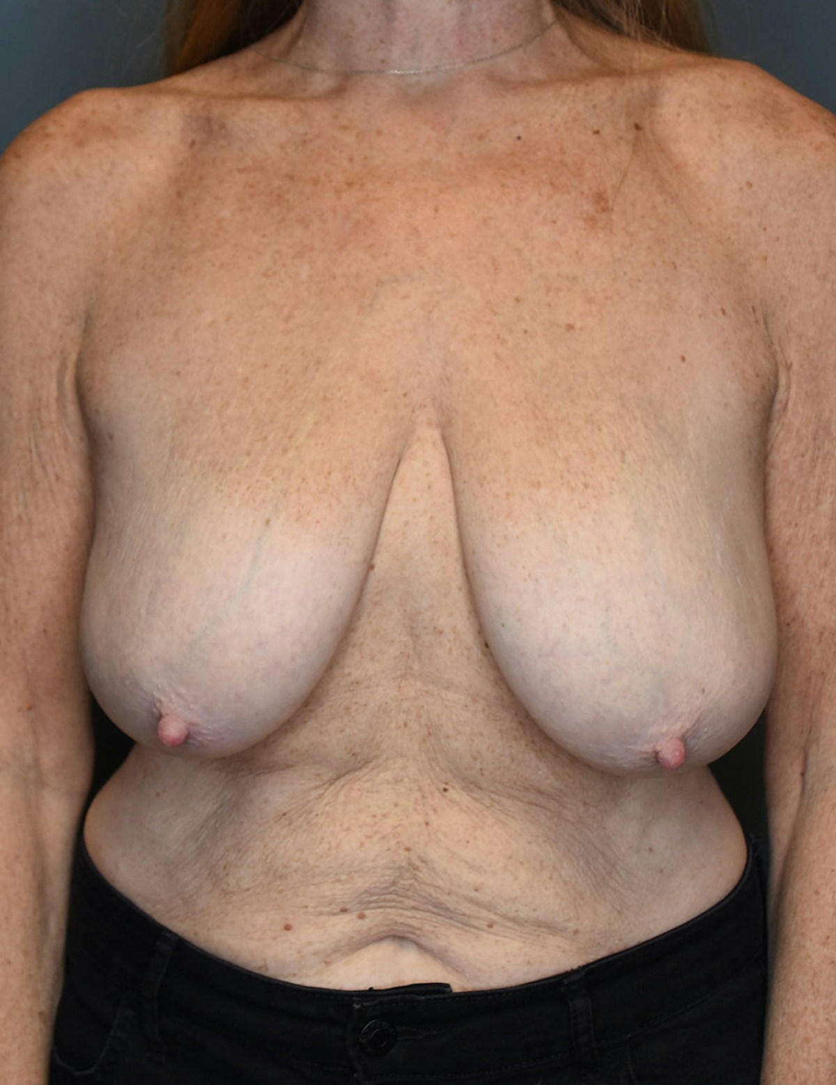 Breast Lift Before & After Gallery - Patient 546496 - Image 9