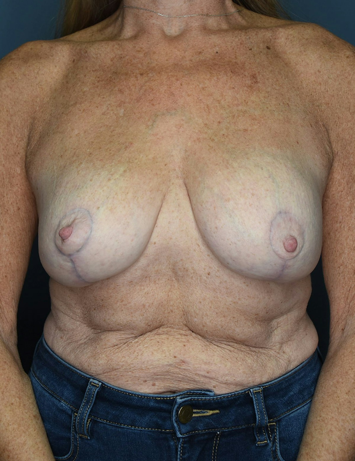 Breast Lift Before & After Gallery - Patient 546496 - Image 10