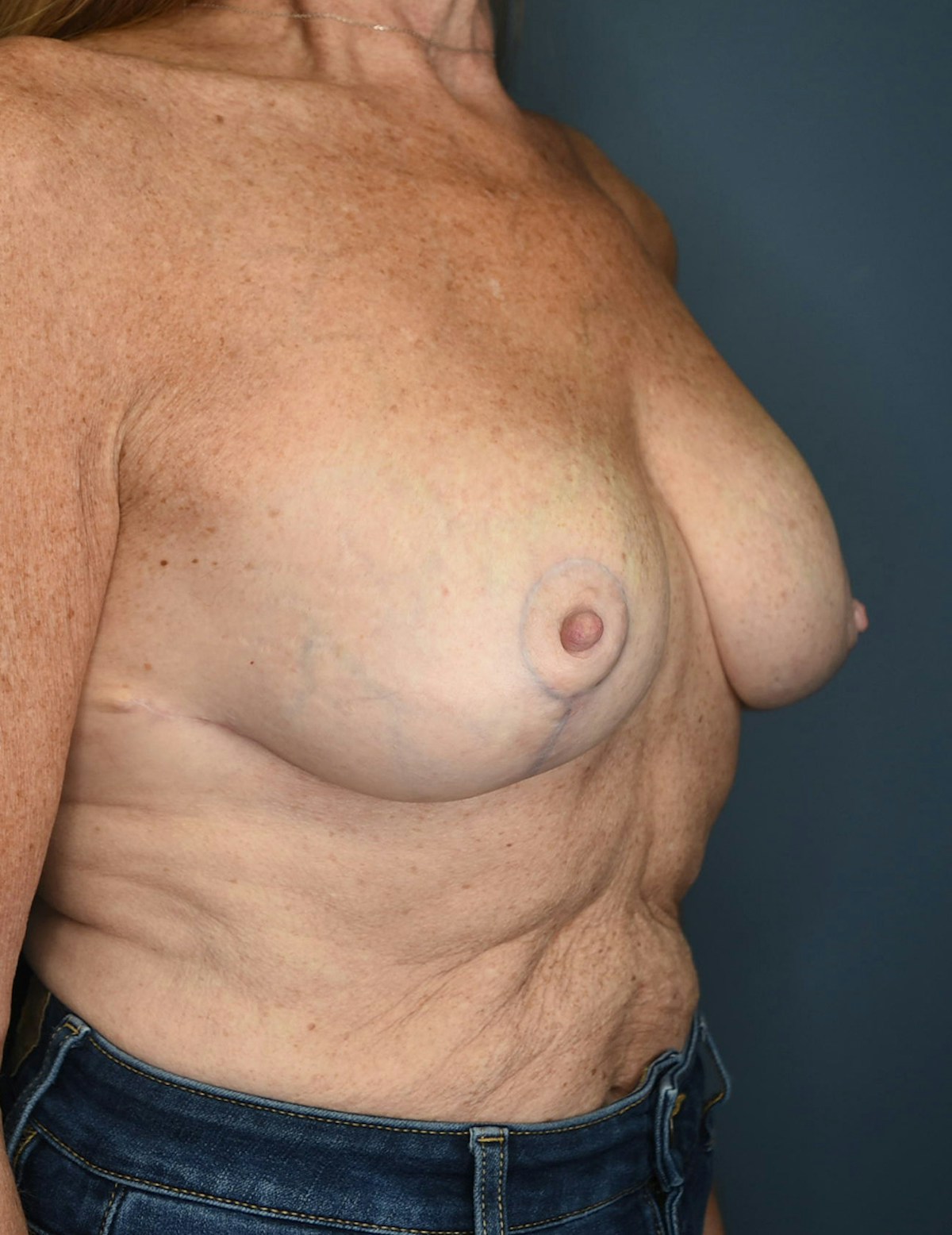 Breast Lift Before & After Gallery - Patient 546496 - Image 4