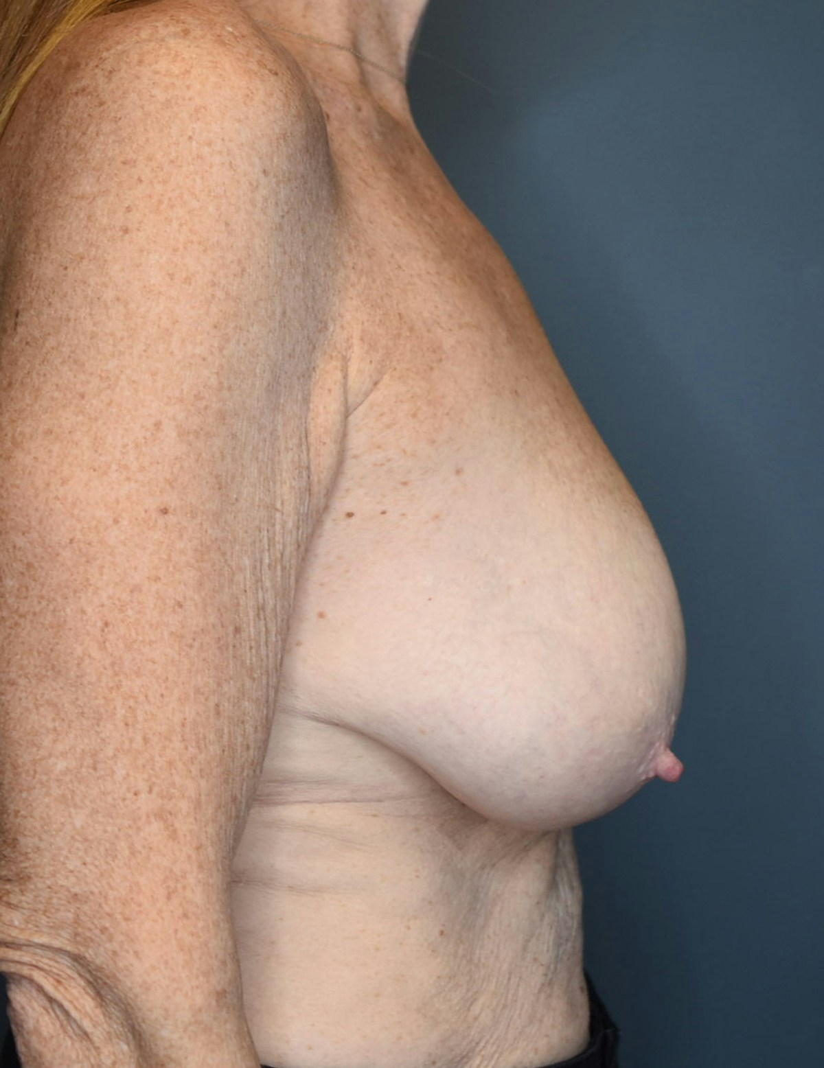 Breast Lift Before & After Gallery - Patient 546496 - Image 7