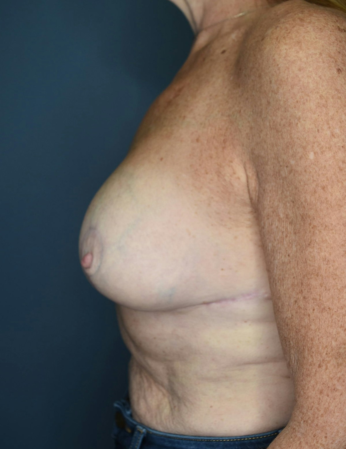Breast Lift Before & After Gallery - Patient 546496 - Image 6