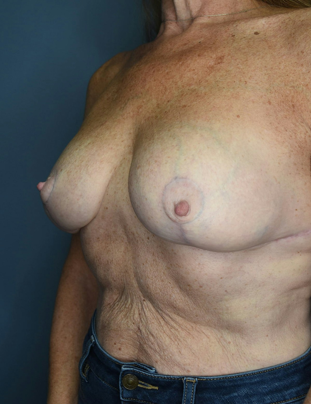 Breast Lift Before & After Gallery - Patient 546496 - Image 2