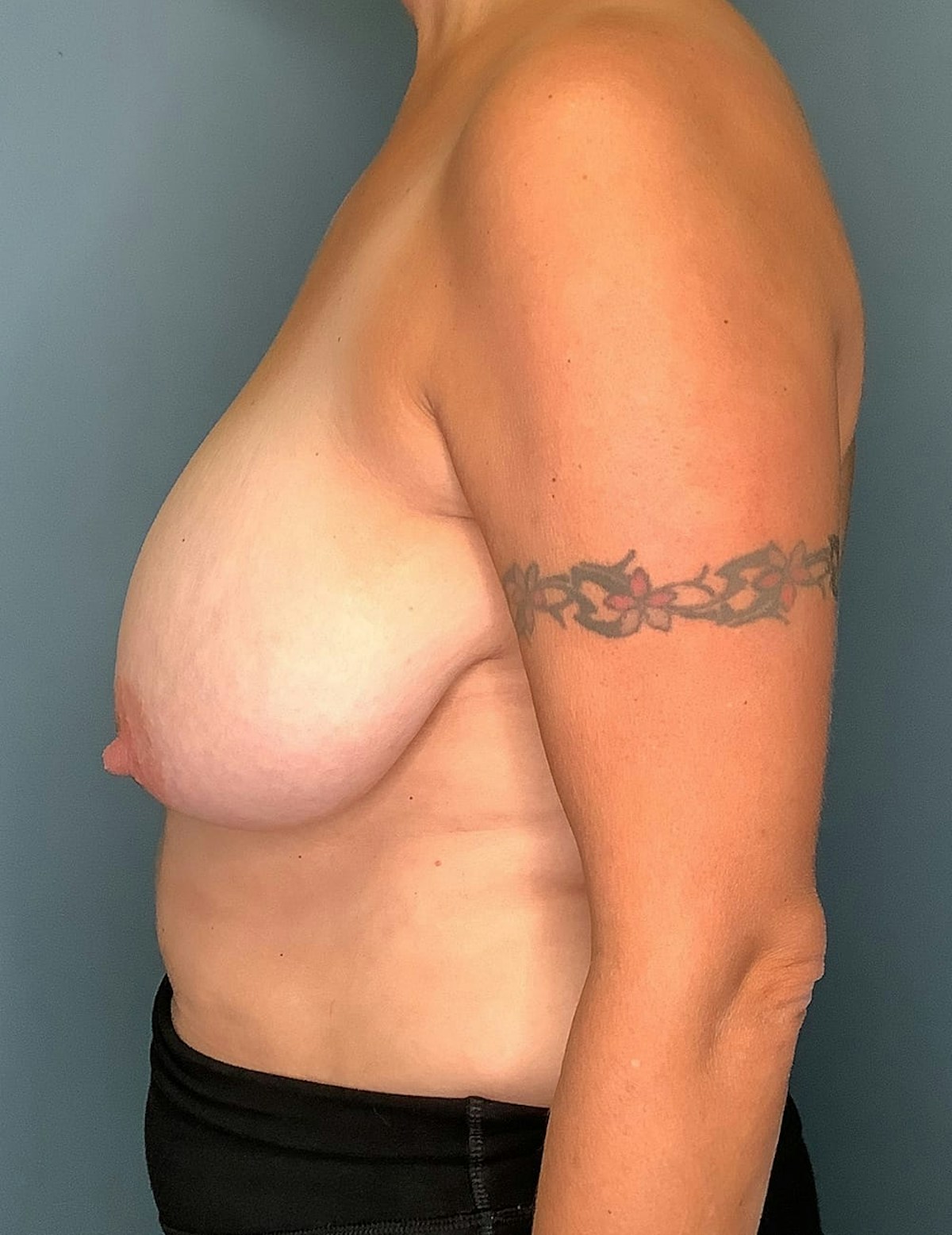 Breast Reduction Before & After Gallery - Patient 142434 - Image 5