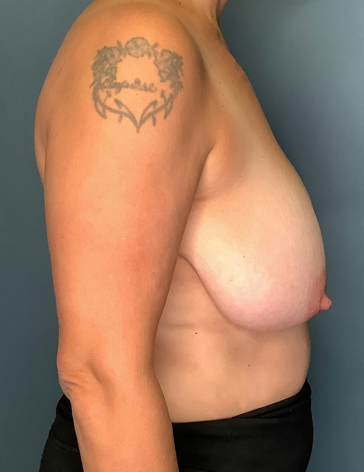 Breast Reduction Before & After Gallery - Patient 142434 - Image 7