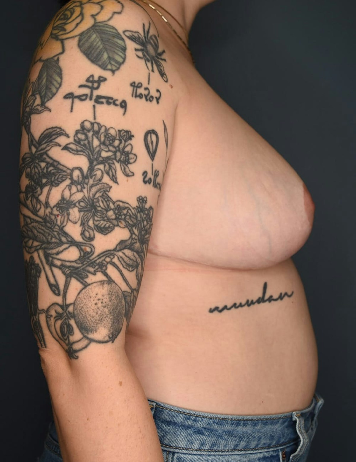 Breast Reduction Before & After Gallery - Patient 219060 - Image 6