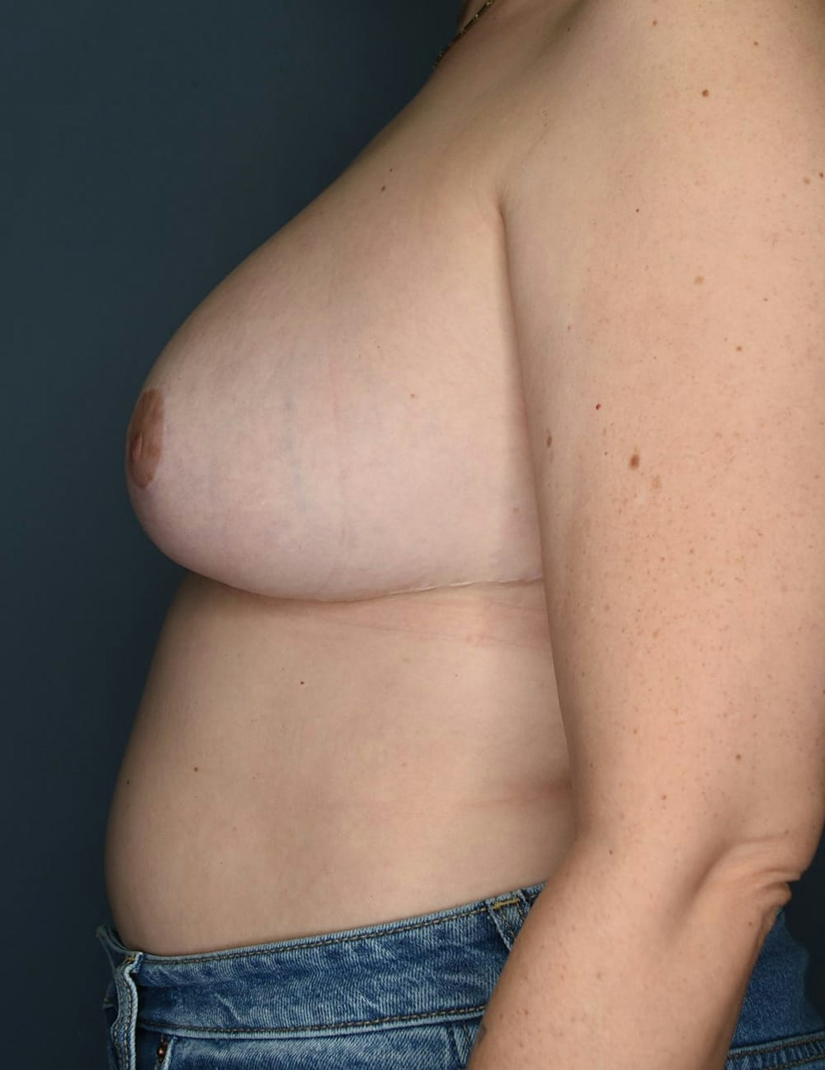 Breast Reduction Before & After Gallery - Patient 219060 - Image 8