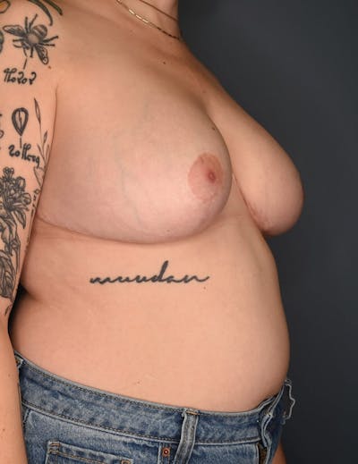 Breast Reduction Before & After Gallery - Patient 219060 - Image 2