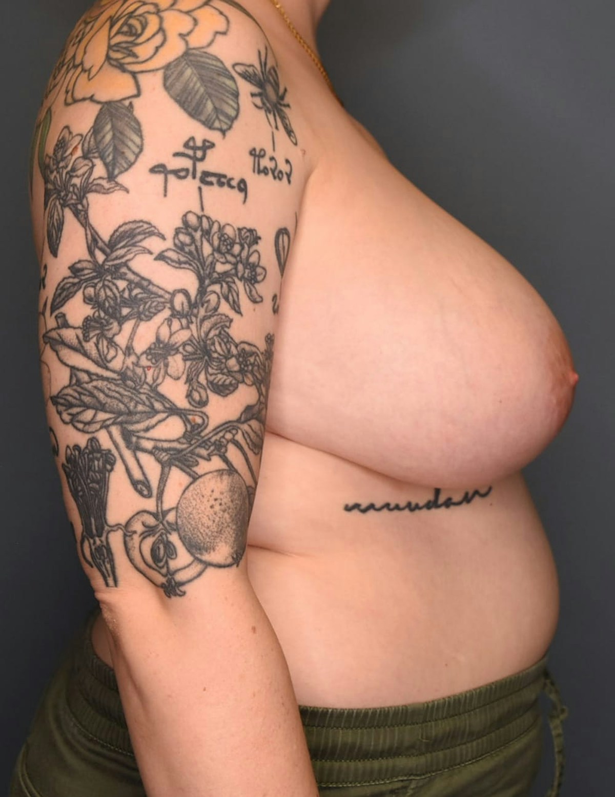 Breast Reduction Before & After Gallery - Patient 219060 - Image 5