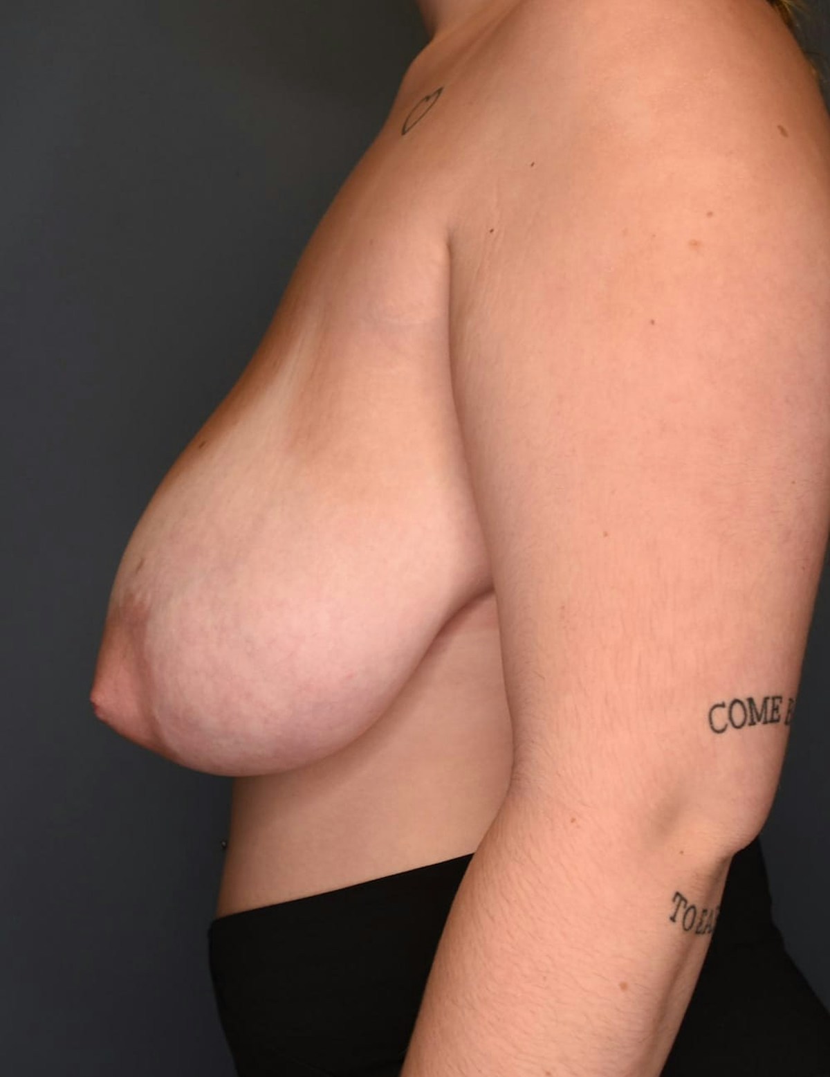 Breast Reduction Before & After Gallery - Patient 219006 - Image 7
