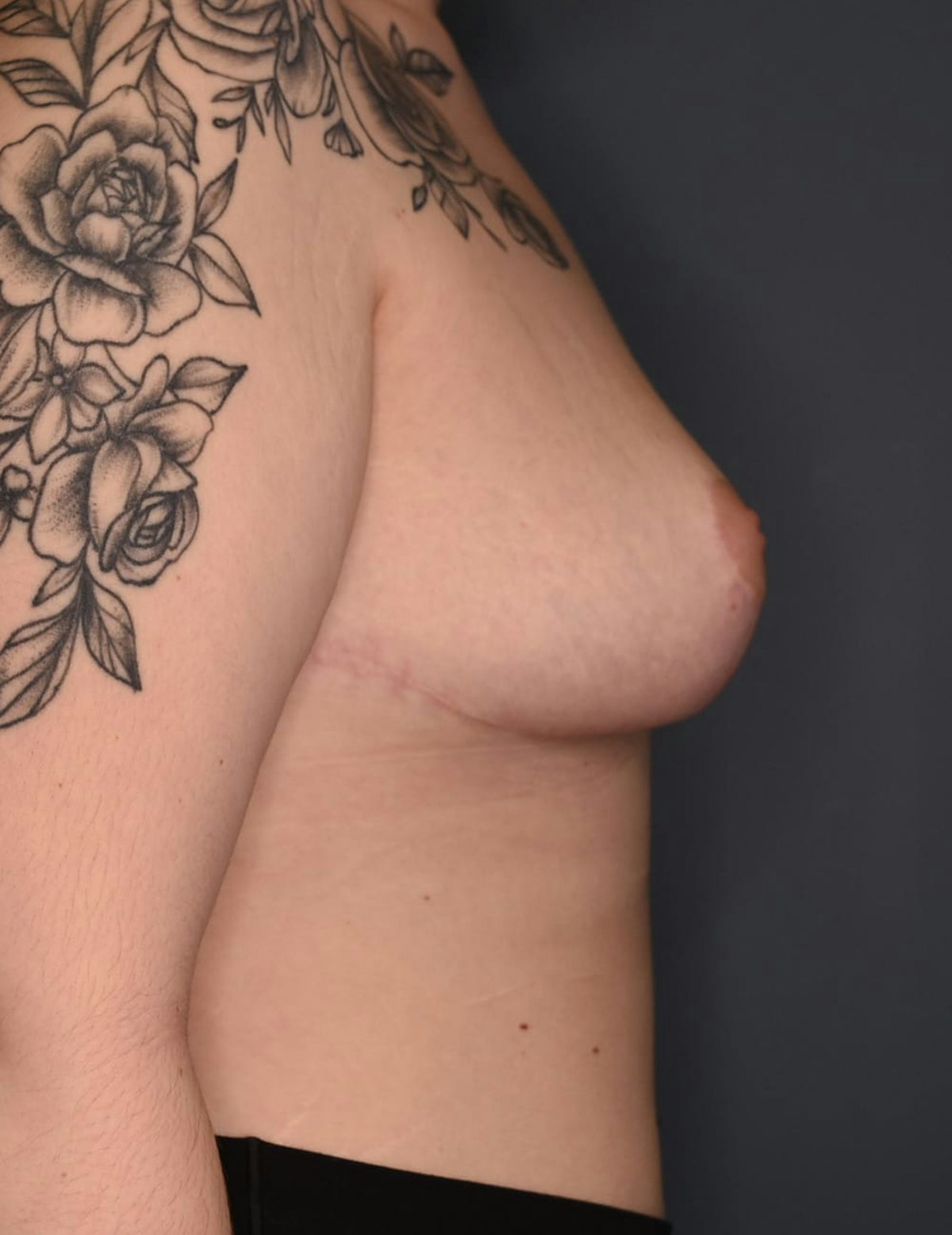 Breast Reduction Before & After Gallery - Patient 219006 - Image 6