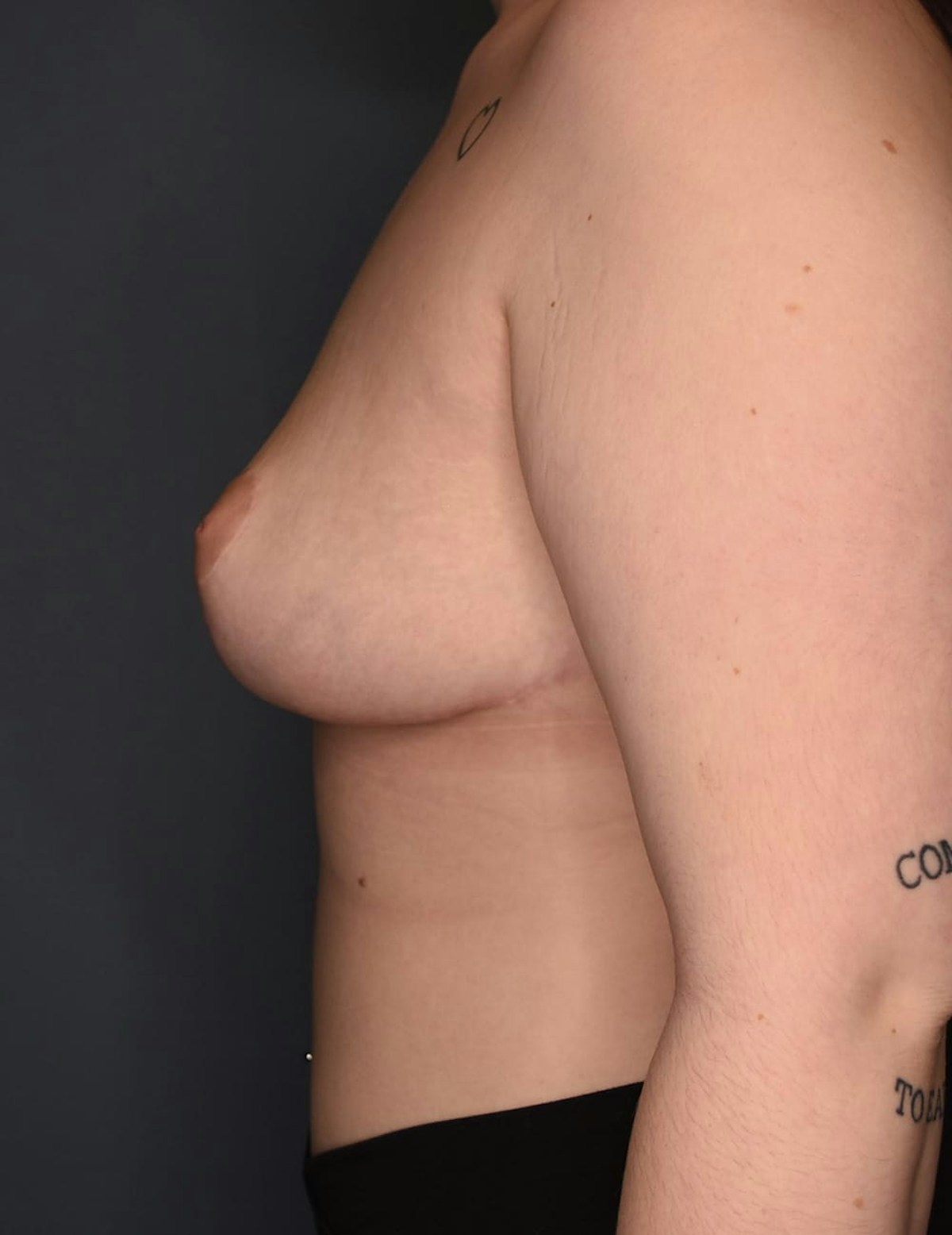 Breast Reduction Before & After Gallery - Patient 219006 - Image 8
