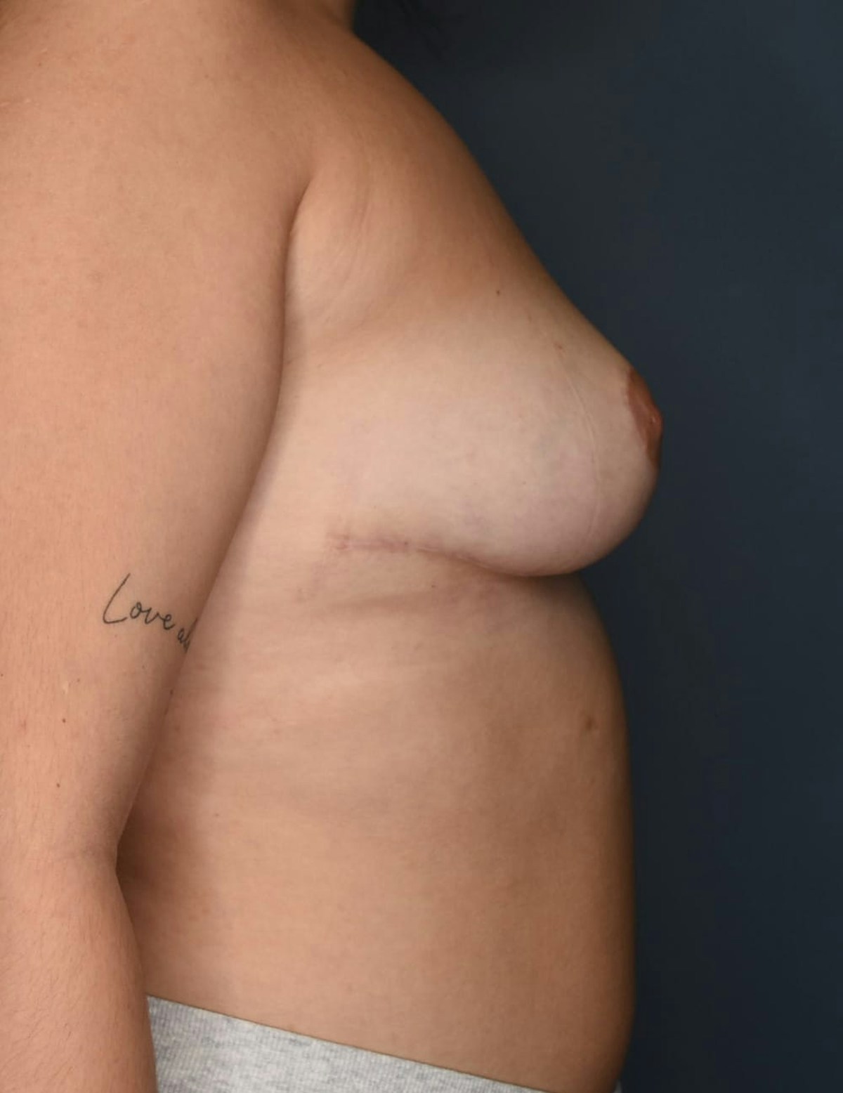 Breast Reduction Before & After Gallery - Patient 700138 - Image 6