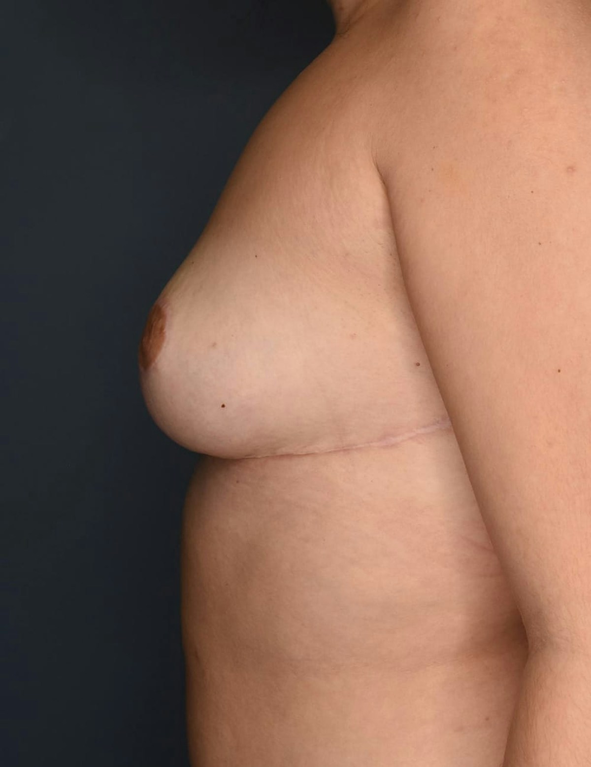 Breast Reduction Before & After Gallery - Patient 700138 - Image 8