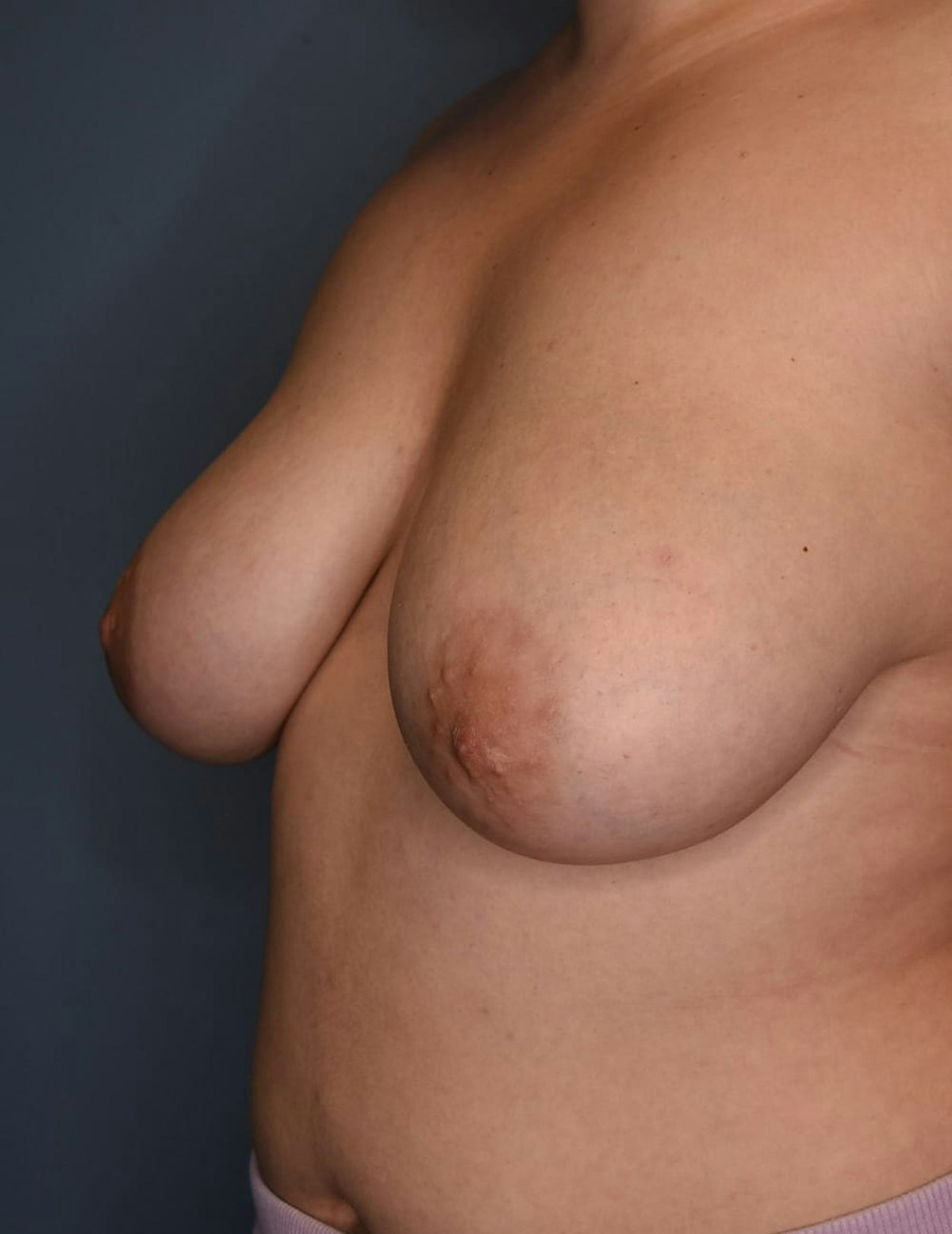 Breast Reduction Before & After Gallery - Patient 700138 - Image 3