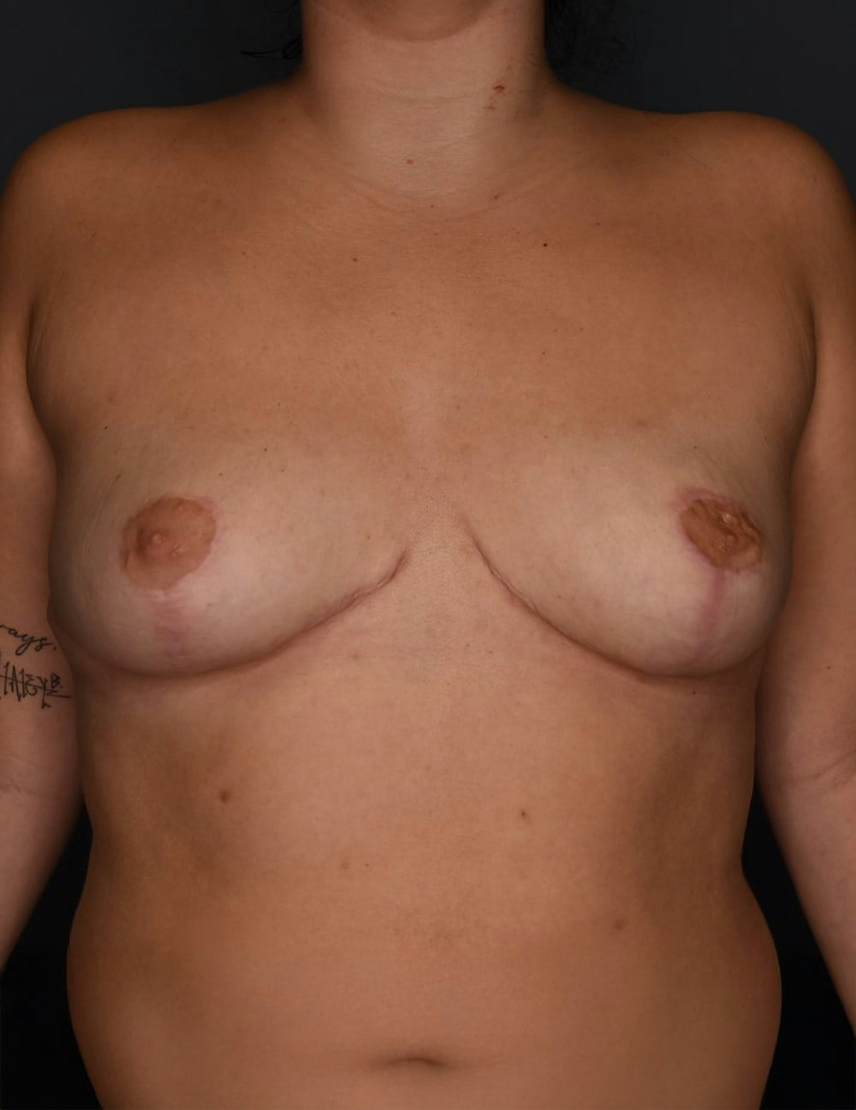 Breast Reduction Before & After Gallery - Patient 700138 - Image 10