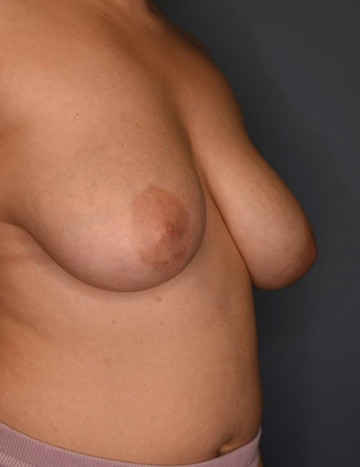Breast Reduction Before & After Gallery - Patient 700138 - Image 1