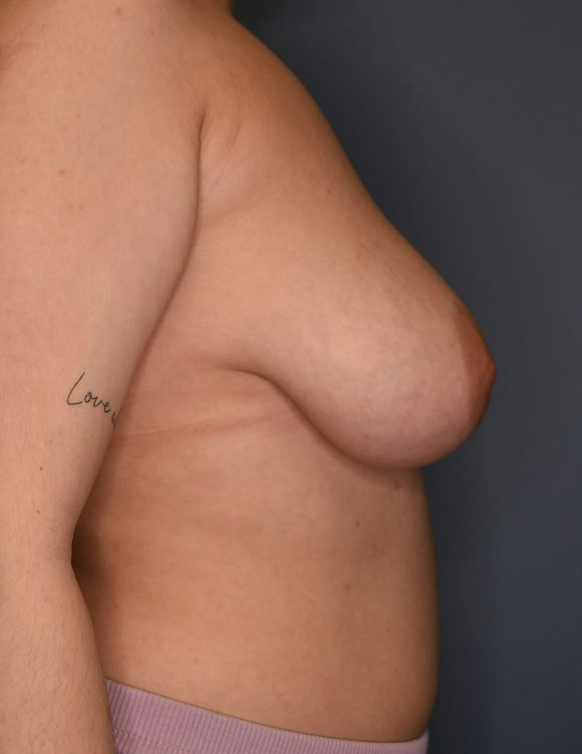 Breast Reduction Before & After Gallery - Patient 700138 - Image 5