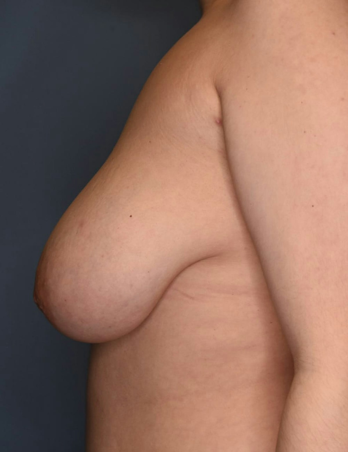 Breast Reduction Before & After Gallery - Patient 700138 - Image 7