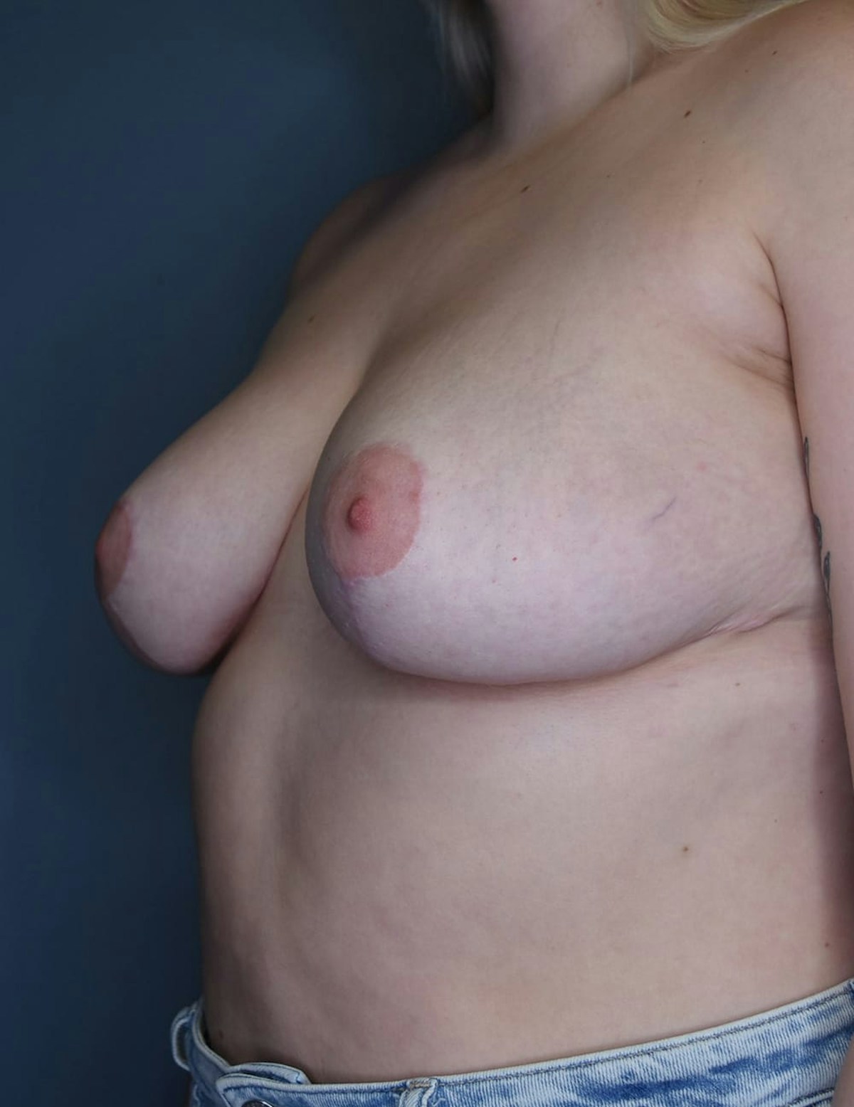 Breast Reduction Before & After Gallery - Patient 110918 - Image 2