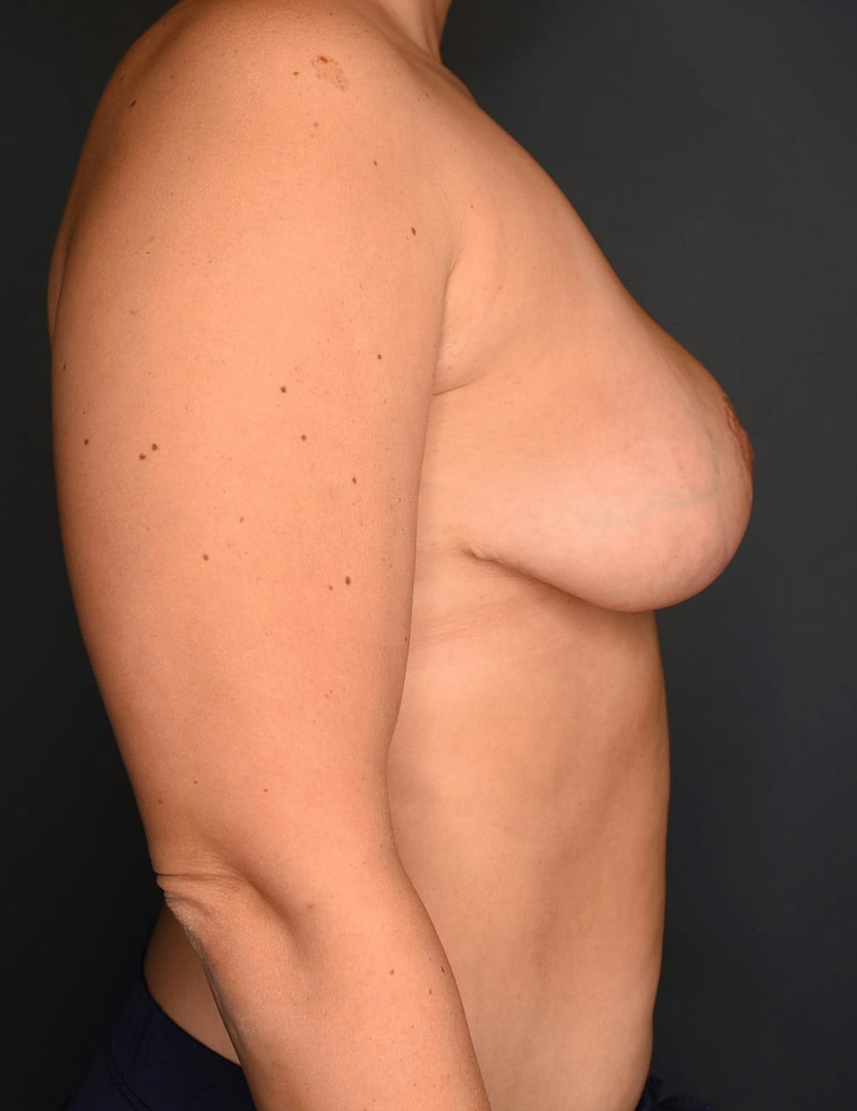 Breast Reduction Before & After Gallery - Patient 253288 - Image 8