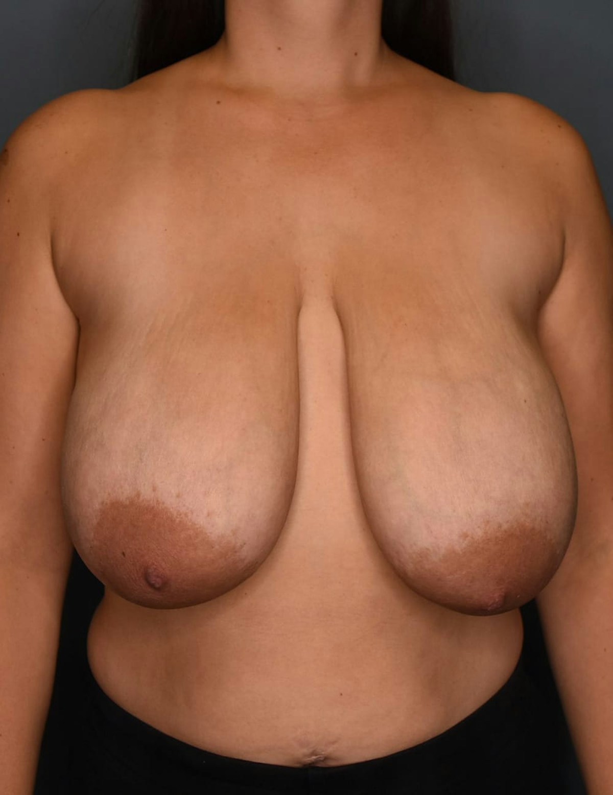 Breast Reduction Before & After Gallery - Patient 253288 - Image 9
