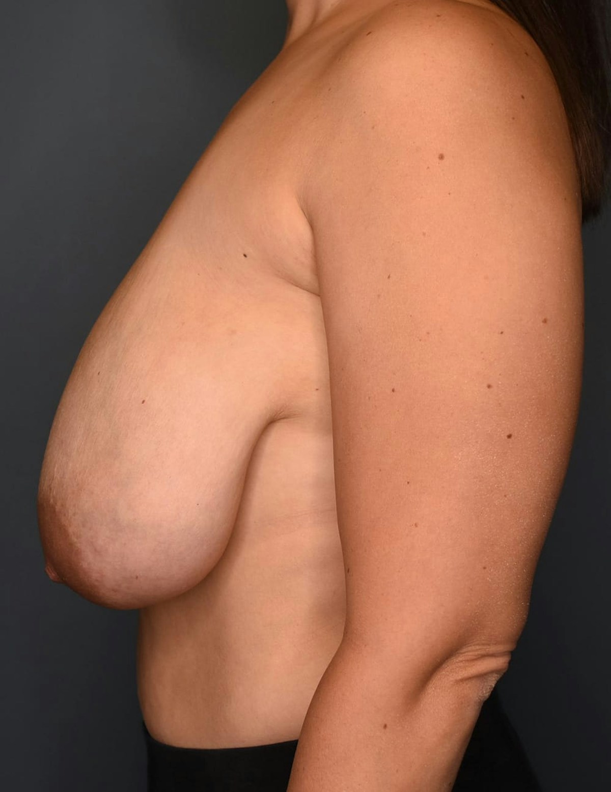 Breast Reduction Before & After Gallery - Patient 253288 - Image 5