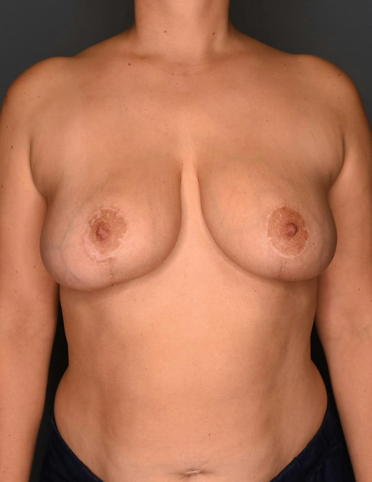 Breast Reduction Before & After Gallery - Patient 253288 - Image 10