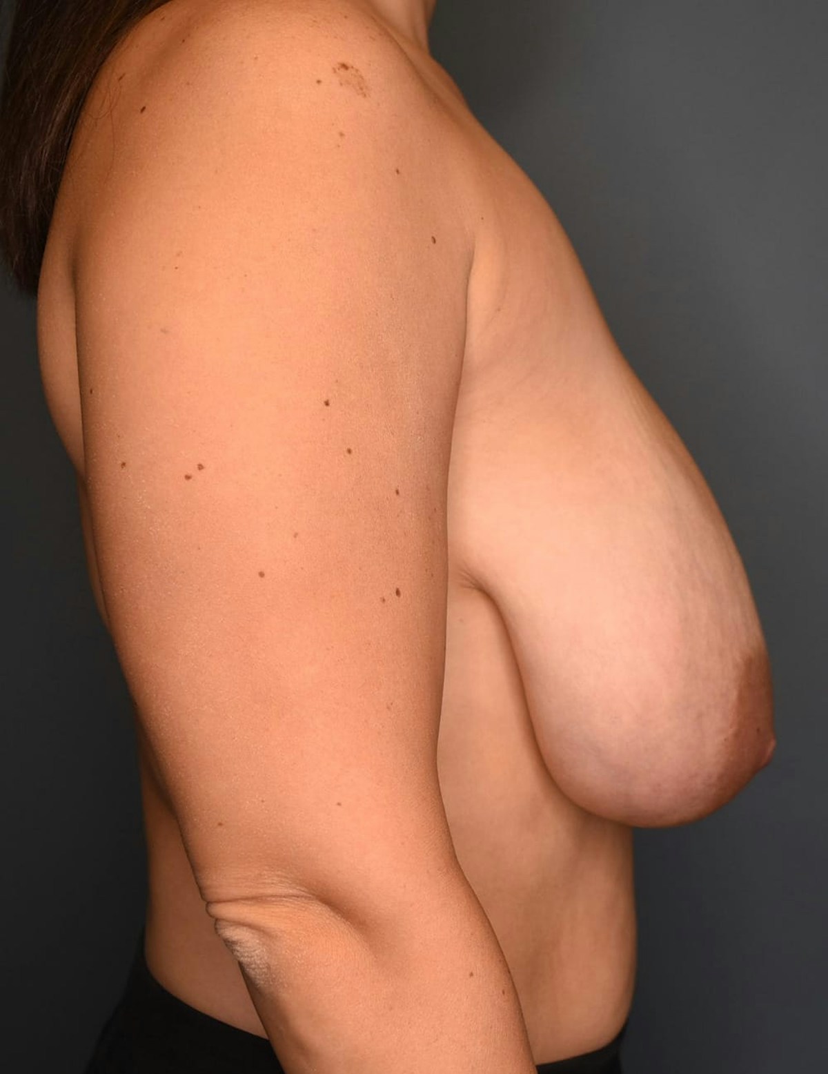 Breast Reduction Before & After Gallery - Patient 253288 - Image 7