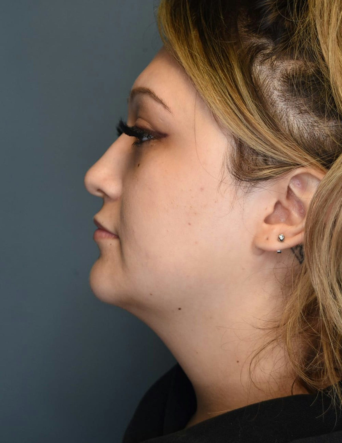 Liposuction Before & After Gallery - Patient 303405 - Image 3