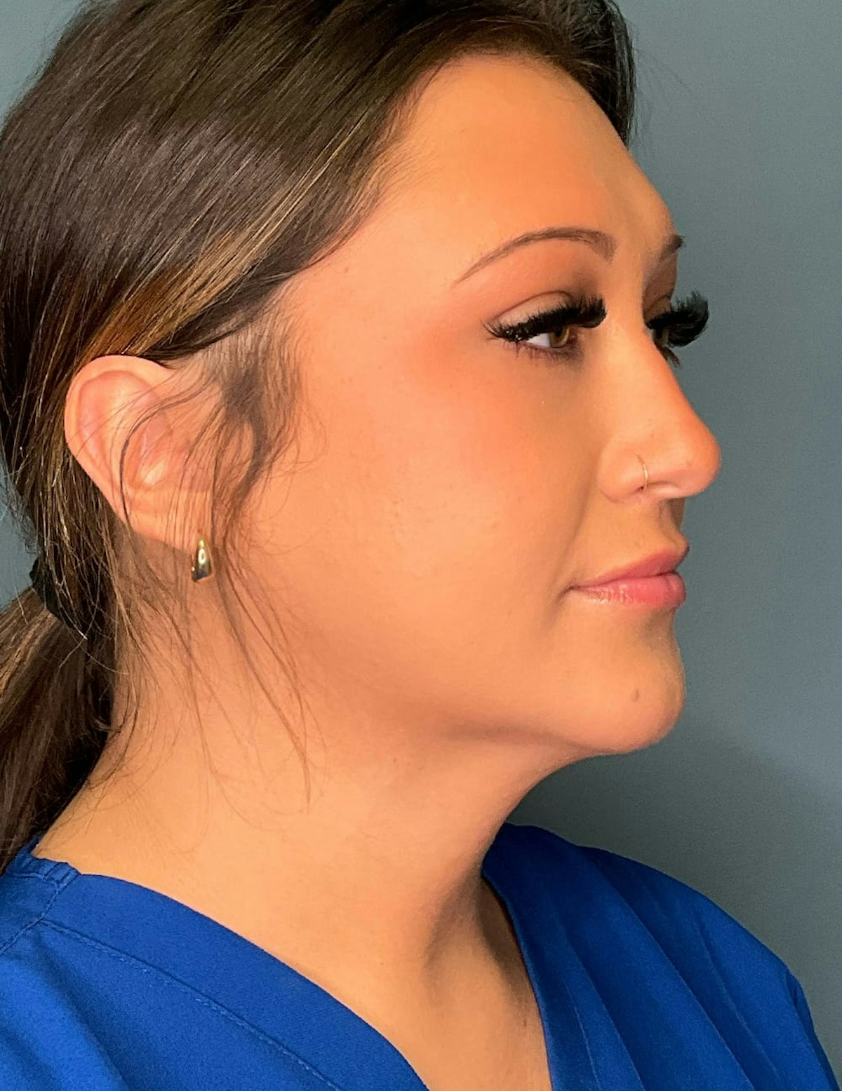 Liposuction Before & After Gallery - Patient 303405 - Image 10