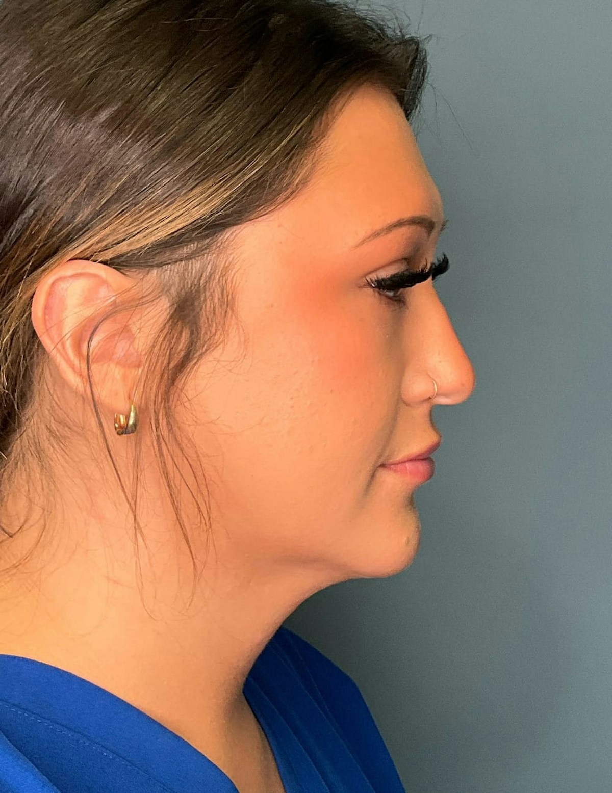 Liposuction Before & After Gallery - Patient 303405 - Image 8