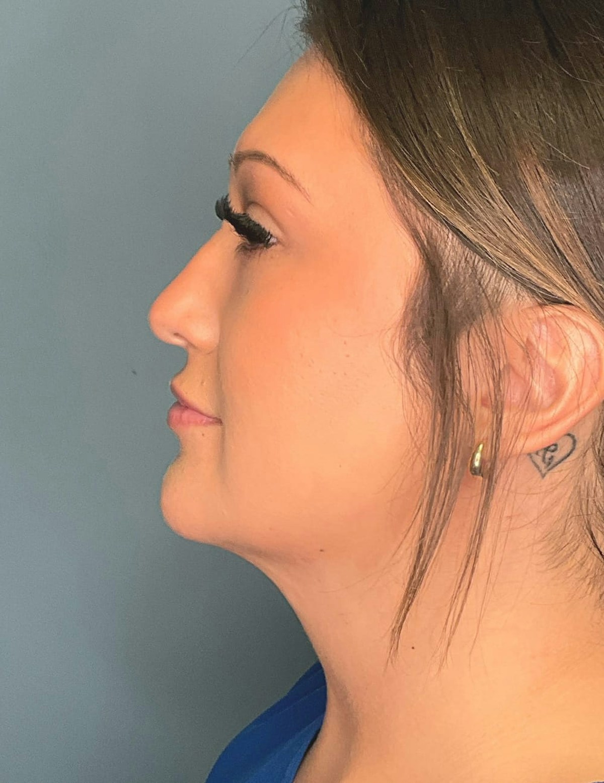 Liposuction Before & After Gallery - Patient 303405 - Image 4