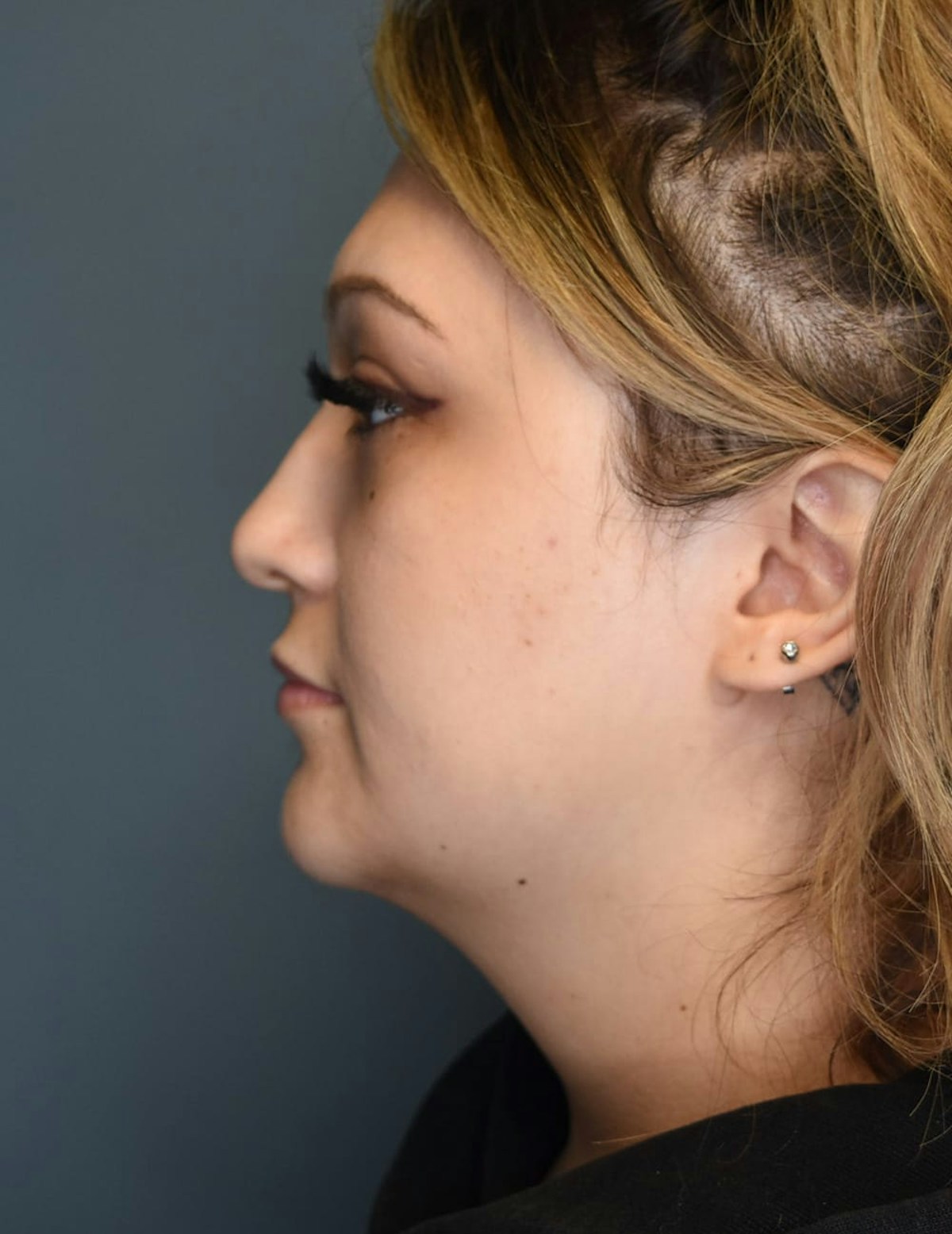 Liposuction Before & After Gallery - Patient 303405 - Image 1