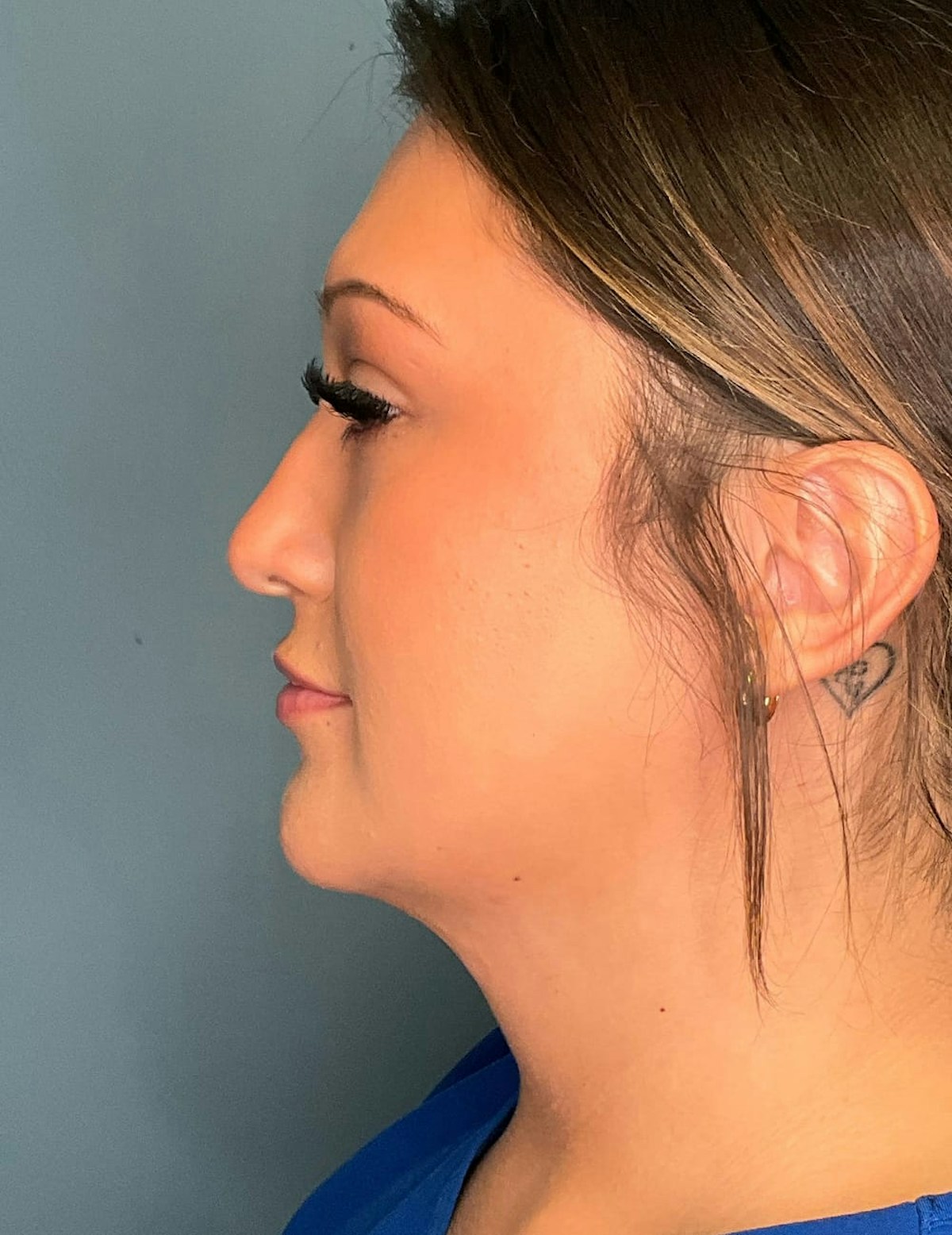 Liposuction Before & After Gallery - Patient 303405 - Image 2