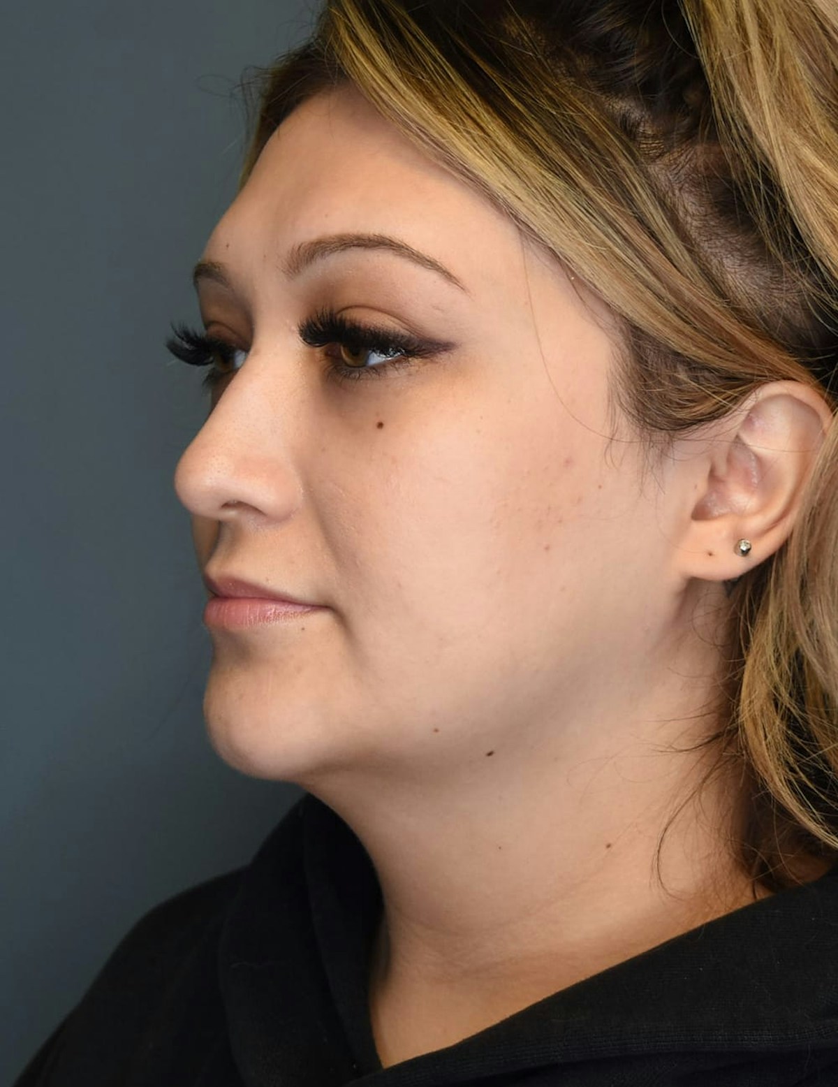 Liposuction Before & After Gallery - Patient 303405 - Image 5