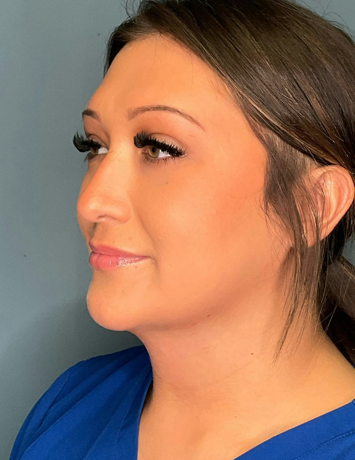 Liposuction Before & After Gallery - Patient 303405 - Image 6