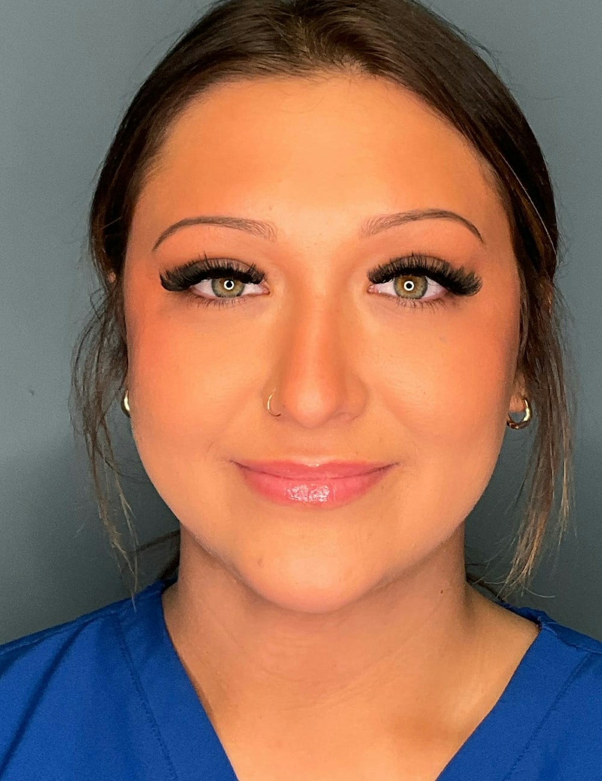 Liposuction Before & After Gallery - Patient 303405 - Image 12