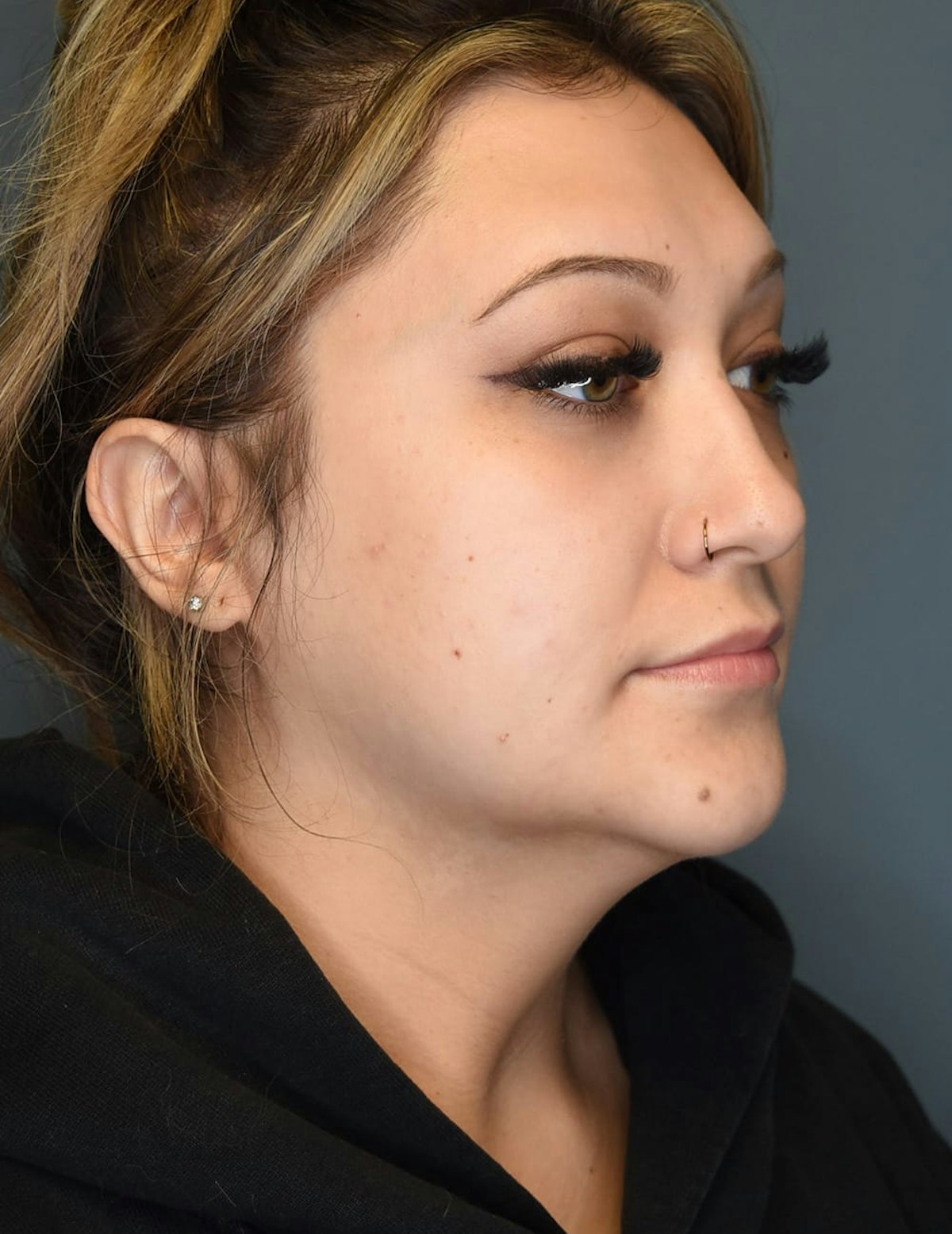 Liposuction Before & After Gallery - Patient 303405 - Image 9